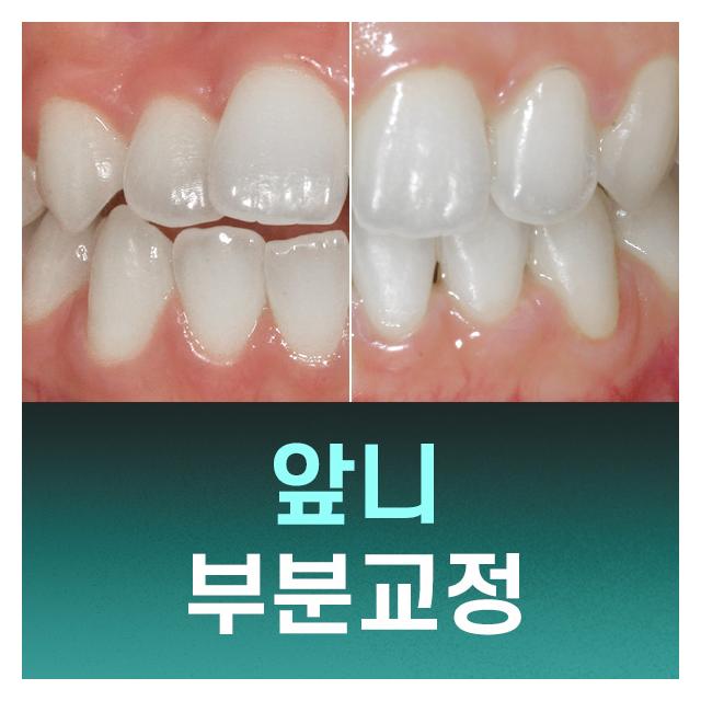 필요한곳만 급속교정 앞니 부분교정으로 아름다운 미소